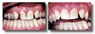 CeramicCrown1