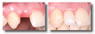 Dental Implant Example 1