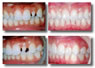 Porcelain Veneers 1